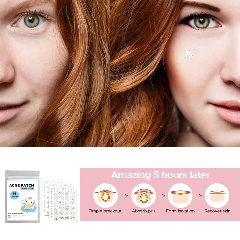 96/100/120pcs Sanrio Cinnamoroll Repair Acne Patch Facial Skin Care Fade Blemishes Pimple Marks Closed Acne