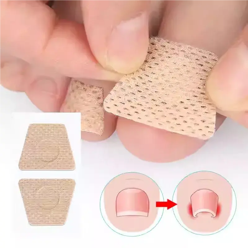 20 Pieces of Nail Care Patches, Suitable for Ingrown Toenails, Protective Patches for Growing Flesh, Onychomycosis Orthopedic Patches