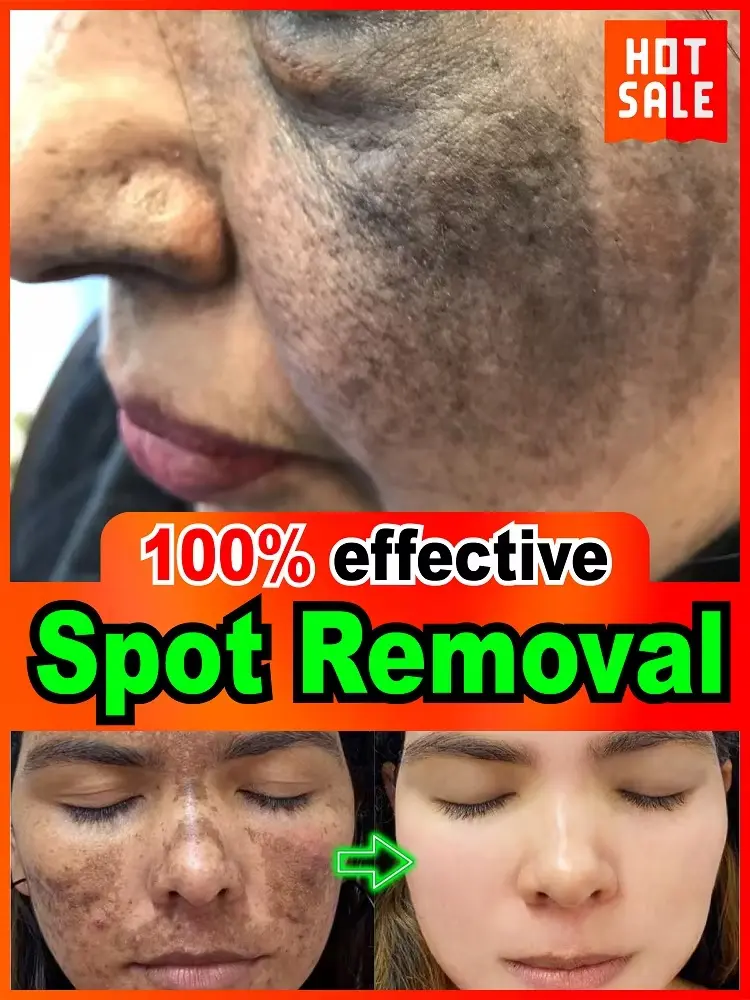 ¹⁰⁰% ˢᵃᶠᵉ ᵃⁿᵈ ᵉᶠᶠᵉᶜᵗⁱᵛᵉ  Regarding facial and body pigmentation, melasma, and pigmentation issues