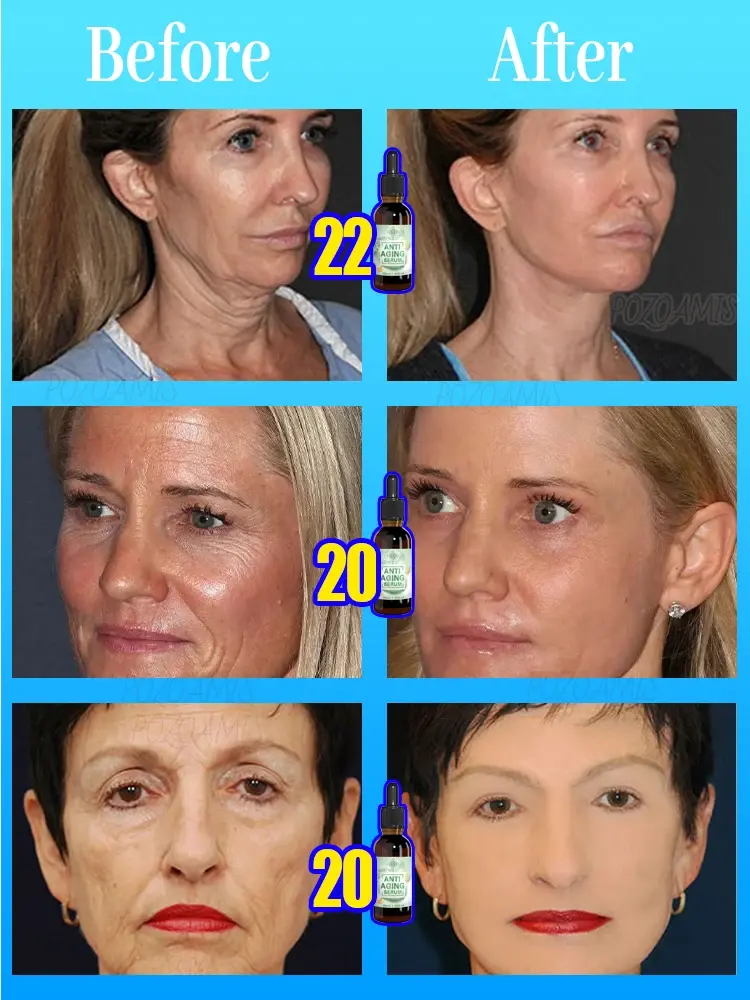 wrinkles disappeared