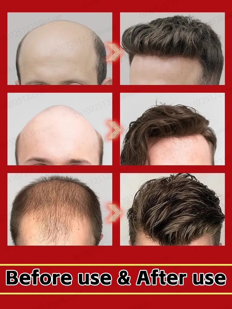 Rosemary hair growth essential oil, repair baldness and hair loss, seborrheic alopecia, hereditary hair loss, middle-aged hair l