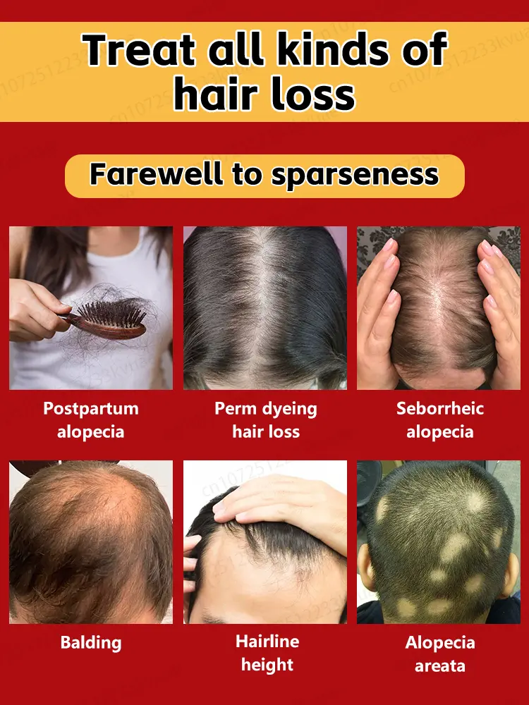 Rosemary hair growth essential oil, repair baldness and hair loss, seborrheic alopecia, hereditary hair loss, middle-aged hair l
