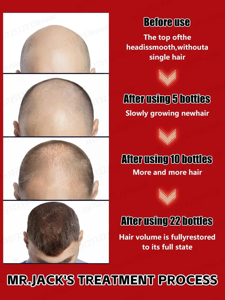 Rosemary hair growth essential oil, repair baldness and hair loss, seborrheic alopecia, hereditary hair loss, middle-aged hair l