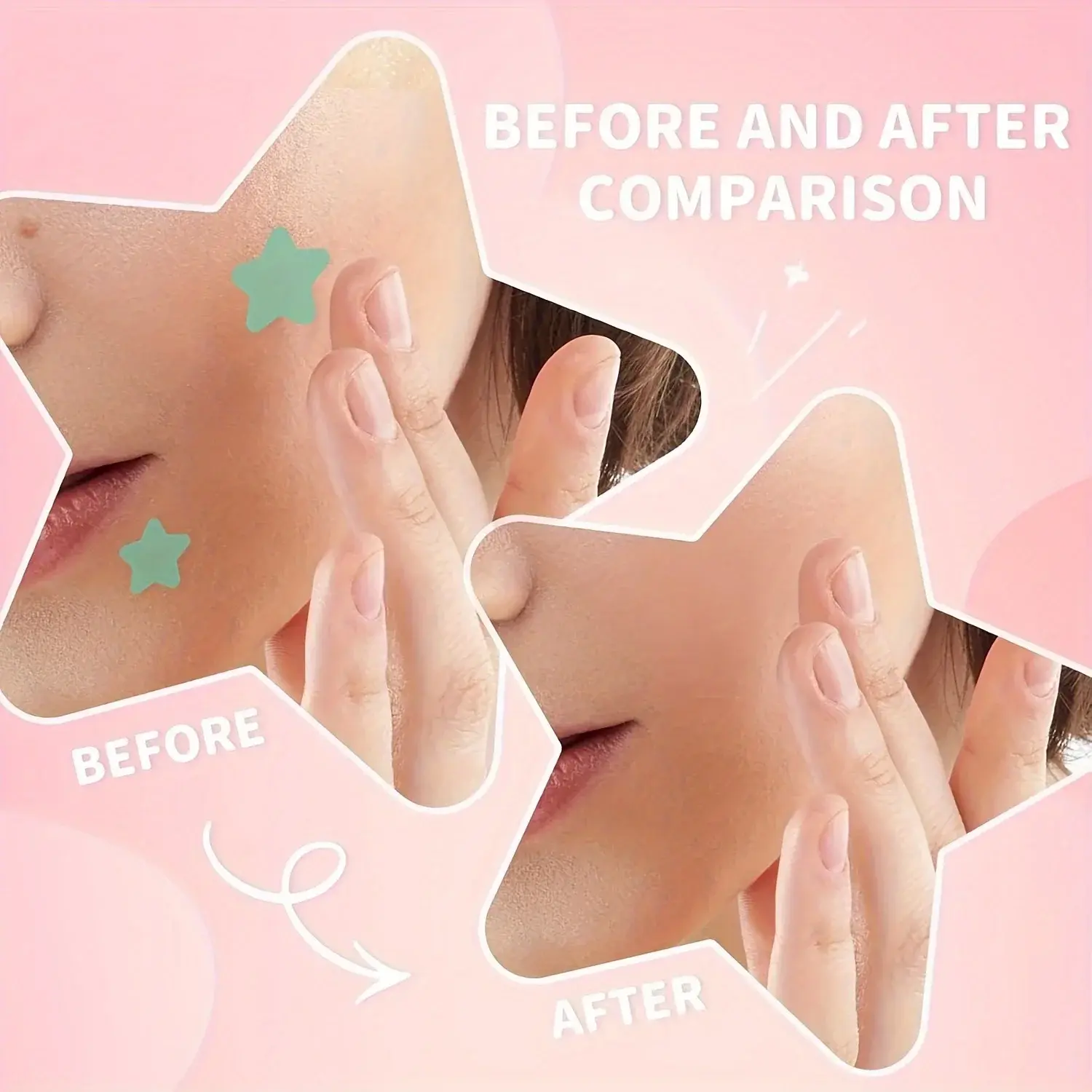 200Pcs Acne Pimple Patch Stickers Waterproof Treatment Blemish Spot Remover Facial Mask Skin Care Tool for Hidden Pimples