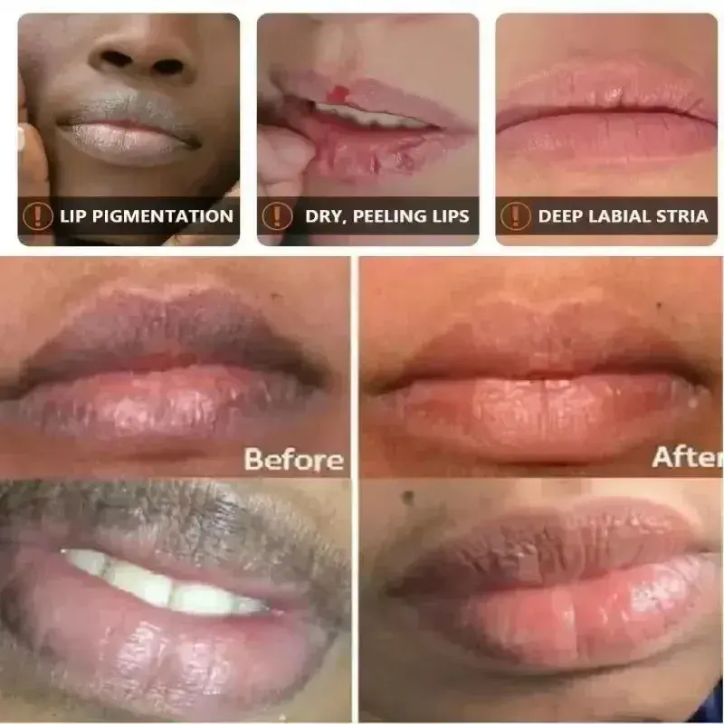 Exfoliating Lip Treatment Gloss Moisturizing Lightening Melanin Lipstick Remove Dark Lip Balm Reduce Lip Lines Improve Dryness