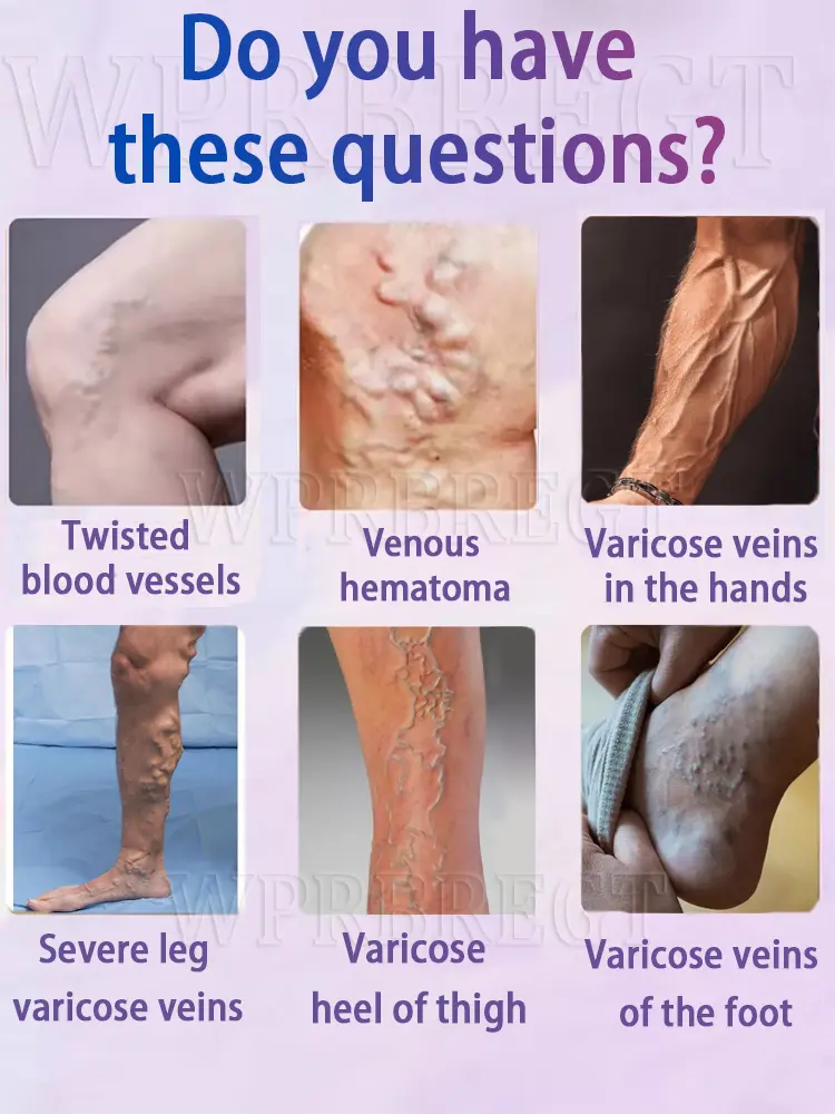 2nd generation varicose vein laser eliminates vasculitis and phlebitis, relieves spider leg pain, laser pointer for treatment