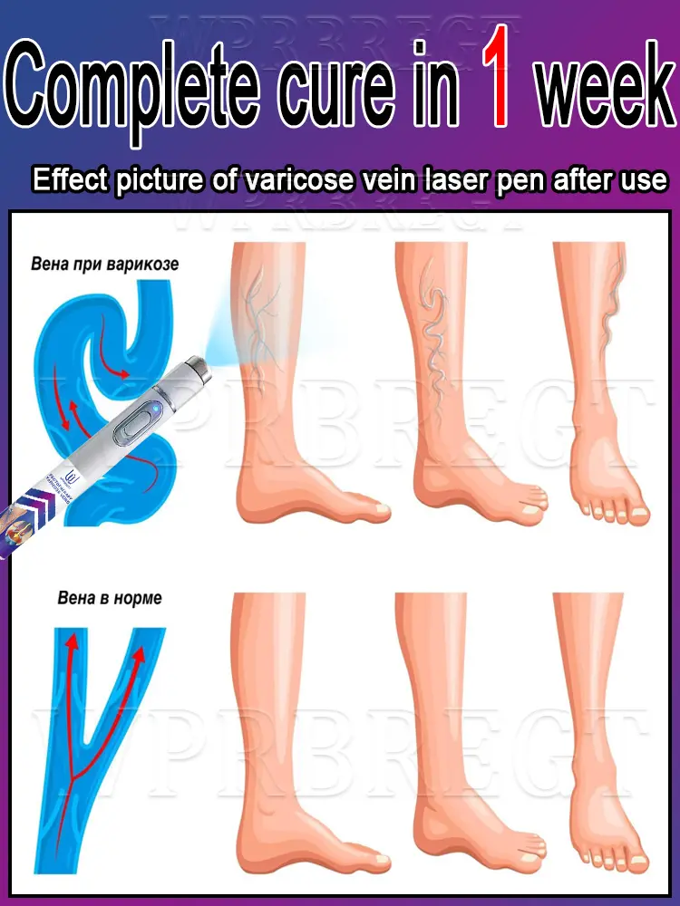 2nd generation varicose vein laser eliminates vasculitis and phlebitis, relieves spider leg pain, laser pointer for treatment