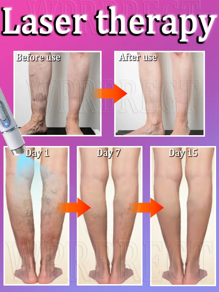 2nd generation varicose vein laser eliminates vasculitis and phlebitis, relieves spider leg pain, laser pointer for treatment