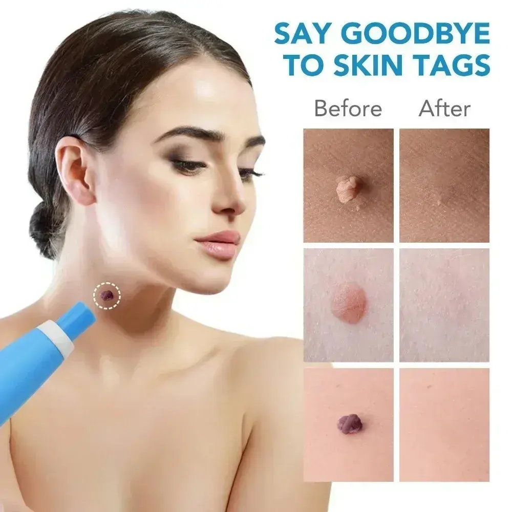 Acne Remover 2 IN 1 Auto Micro Skin Tag Remover Device Tag Removal Kit Adult Mole Wart Remover Face Care Beauty Tools