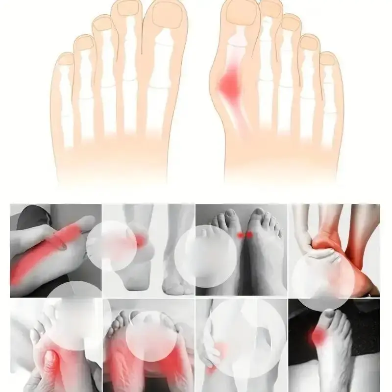1 Pair Super Elastic Bunion Sleeve Bunion Corrector Protector PreventHallux Valgus - Foot Caring Toe Corrector