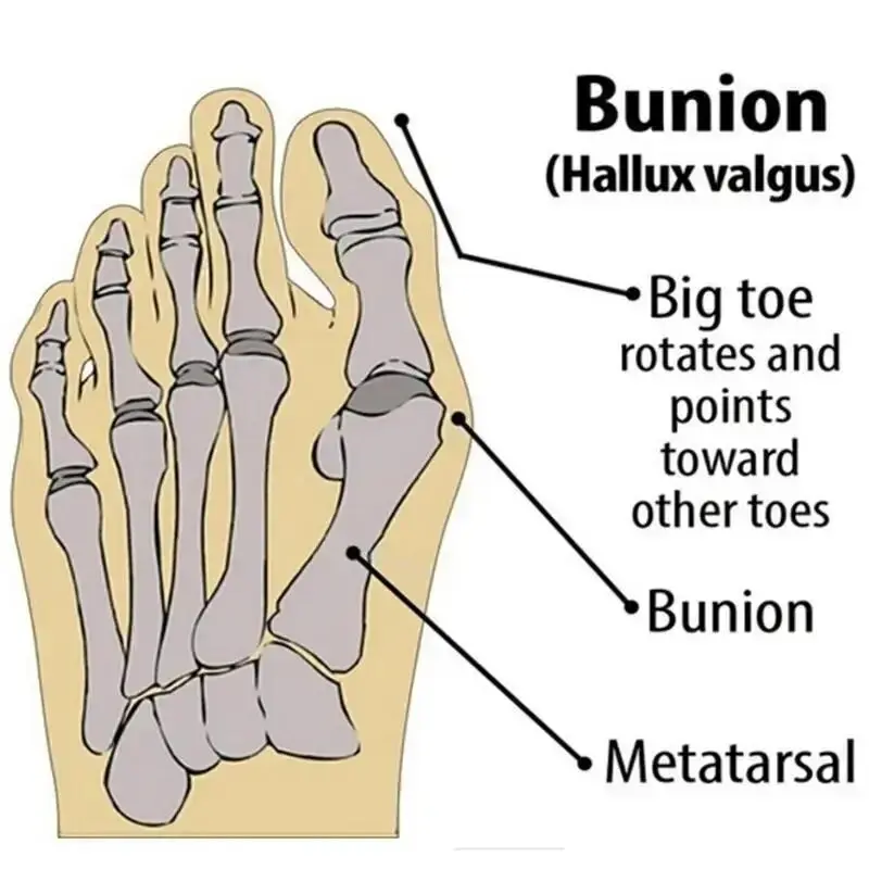 1 Pair Super Elastic Bunion Sleeve Bunion Corrector Protector PreventHallux Valgus - Foot Caring Toe Corrector