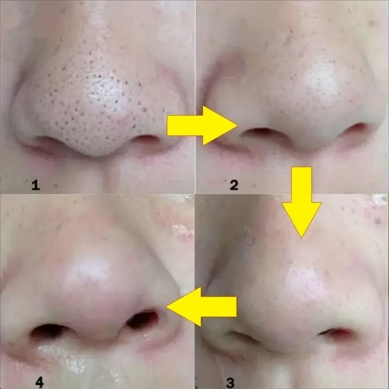 30pcs Blackhead Nose Strips Deep Cleansing Nasal Spot Facial Dot Stickers Nose Mask Shill For Acne & Black Head - Dropship