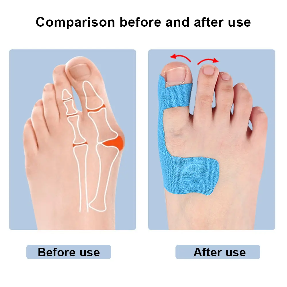 10Pcs Bunion Corrector Bunion Straightener Breathable Toe Separator Self Adhesive Hallux Valgus Orthosis Corrector for Men Women