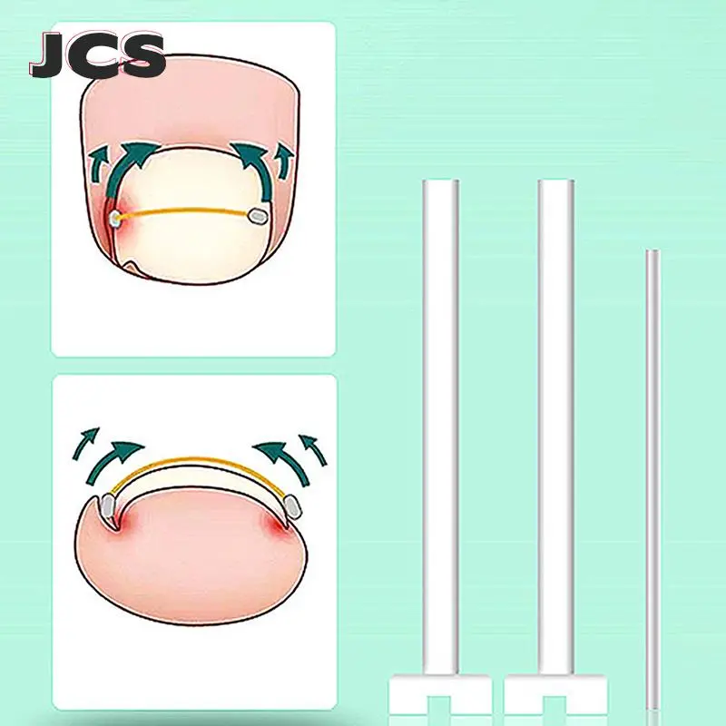 Ingrown Toenail Corrector Tools Pedicure Recover Embed Toe Nail Treatment Professional Ingrown Toenail Straightening Clip Brace