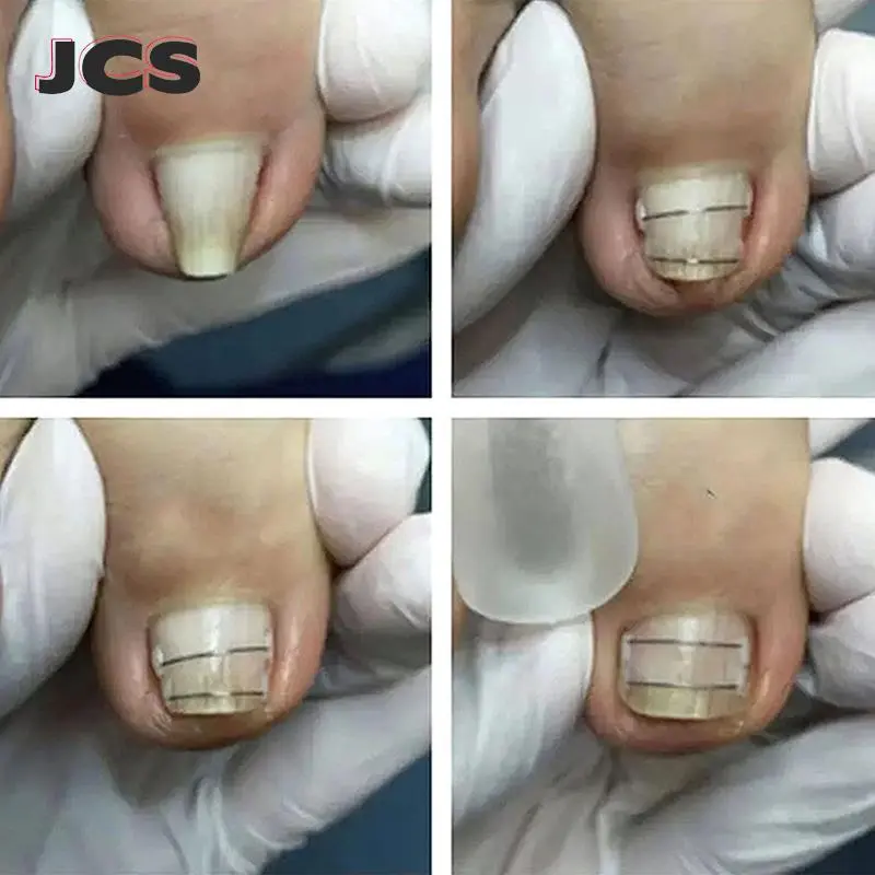 Ingrown Toenail Corrector Tools Pedicure Recover Embed Toe Nail Treatment Professional Ingrown Toenail Straightening Clip Brace
