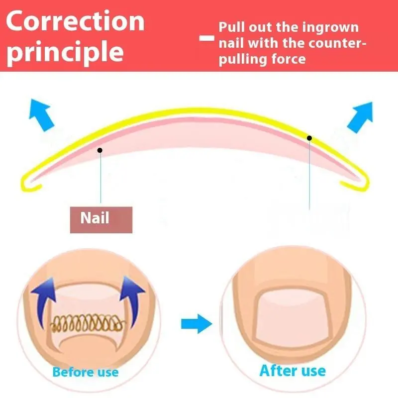 Ingrown Toenail Corrector Tools Pedicure Recover Embed Toe Nail Treatment Professional Ingrown Toenail Correction Foot CareTool