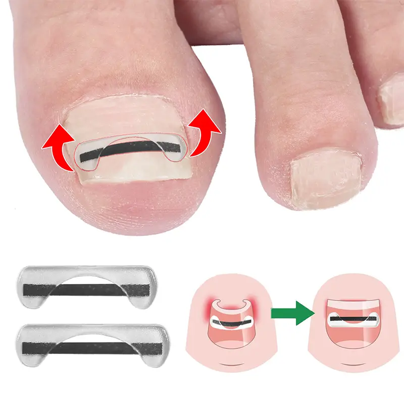Titanium Alloy Toenail Correction Wire Ingrown Nail Treatment Device Stickers Silicone Tool Foot Care Accessories Daily Use