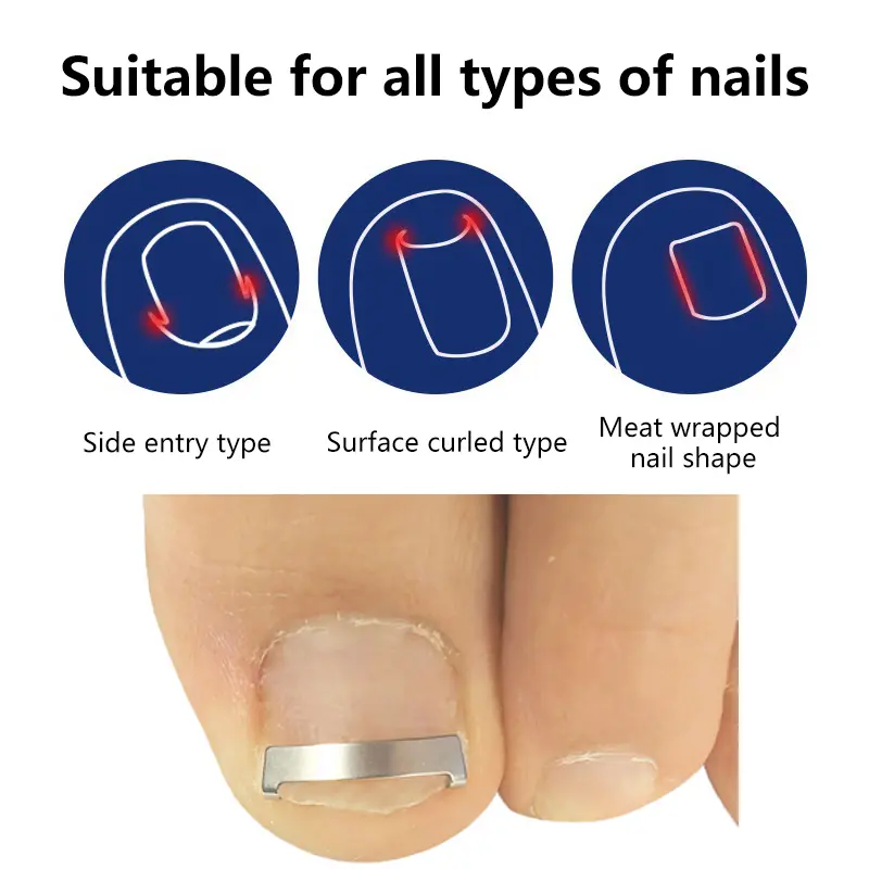 Ingrown Toenail Corrector Tools Pedicure Recover Embed Toe Nail Treatment Professional Ingrown Toenail Correction Foot Care Tool