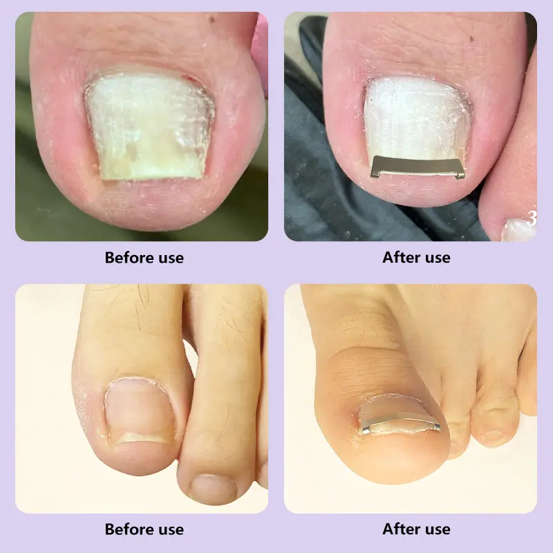 Ingrown Toenail Corrector Tools Pedicure Recover Embed Toe Nail Treatment Professional Ingrown Toenail Correction Foot Care Tool