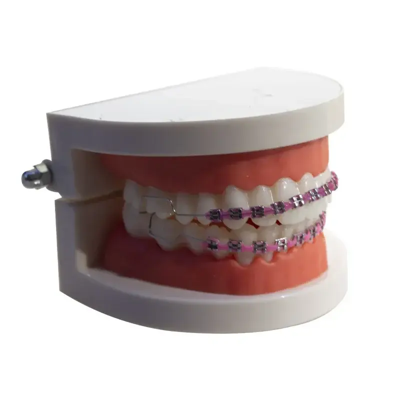1 paar tijdelijke tanddecoratie met metalen draden veelkleurige metalen beugel orthodontische ligatuurbanden tandartsmateriaal